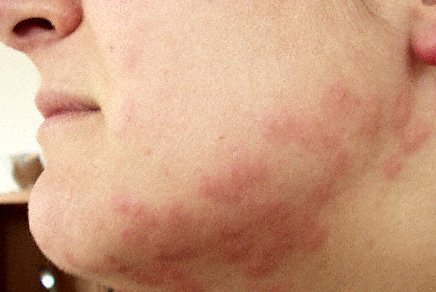 bed bug bite on neck